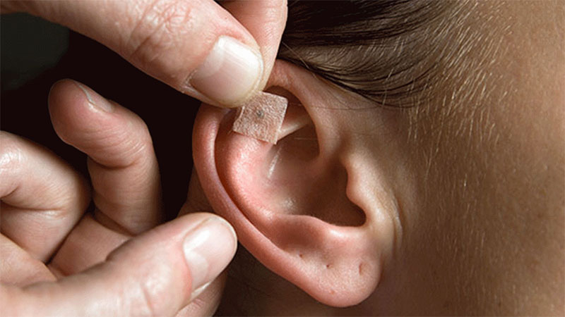 A auriculoterapia utiliza pontos na pele do ouvido externo para diagnosticar e tratar dor e condições médicas do corpo